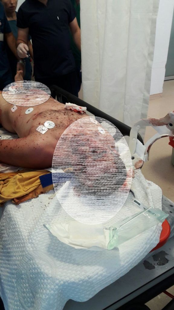 Kamuoyundan sır gibi saklanan define olayında 2 kişi ağır yaralandı. Dinamitli define olayında 2 kişi ağır yaralandı